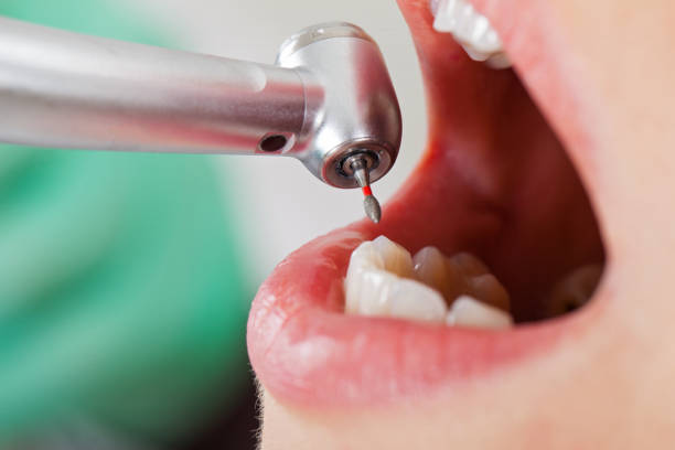 Best Knocked-Out Tooth (Avulsed Tooth) Treatment in Meeker, OK